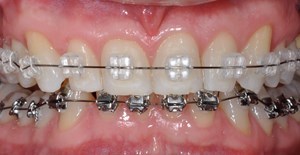 Tandfarvede og metal brackets kan kombineres.