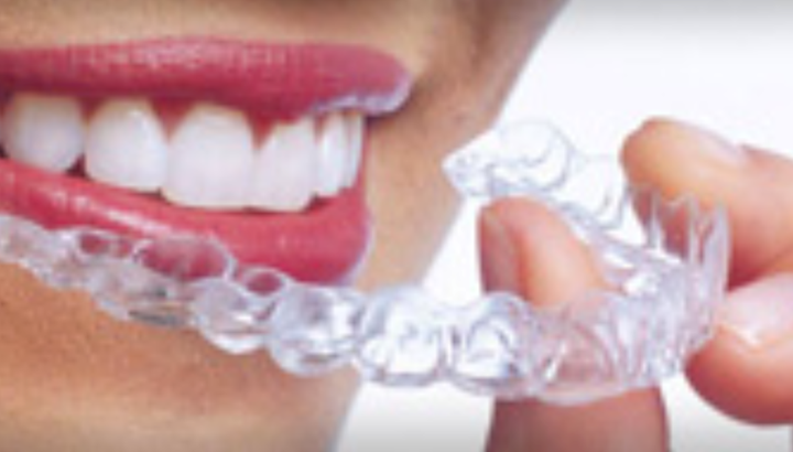 Aligners, Invisalign