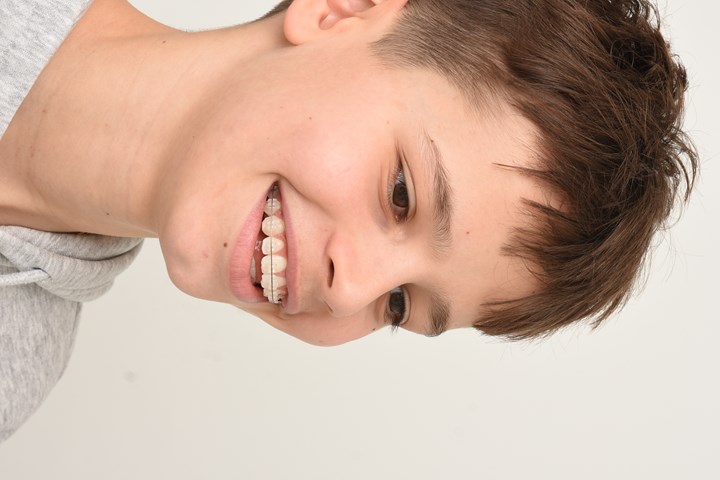 Hvide brackets kombineret med hvid bue.