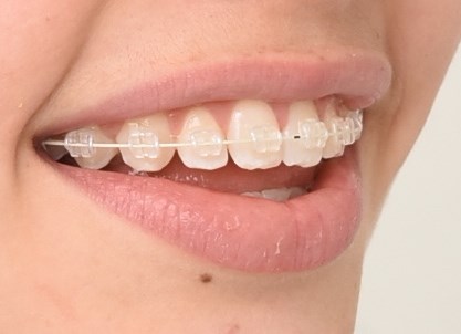 Tandfarvede brackets kombineret med metalbure er ofte en hensigtsmæssigt valg