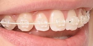 Brackets, tandfarvede og metal