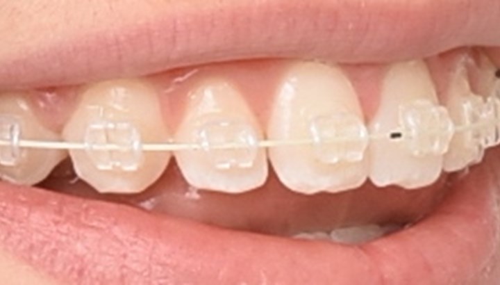 Brackets, tandfarvede og metal