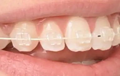 Brackets, tandfarvede og metal
